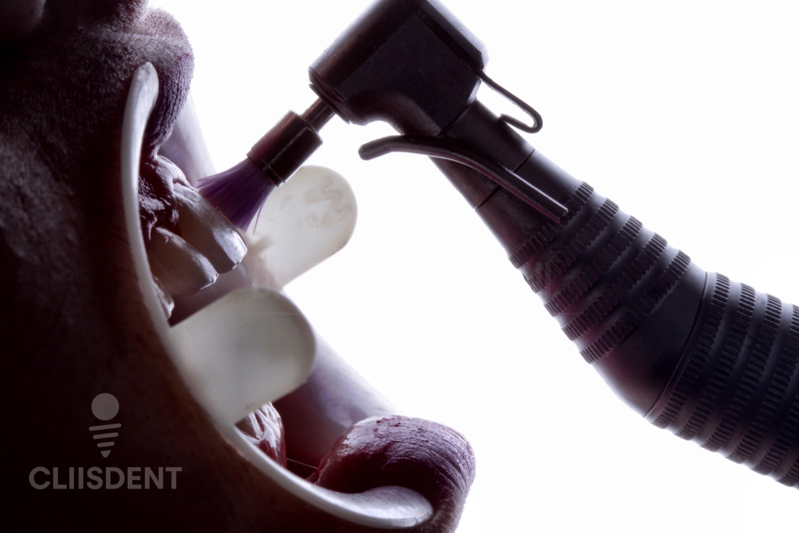 Procedimento de colocação de implante dentário na Cliisdent