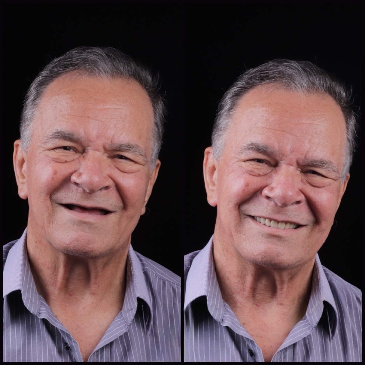 Antes e depois de reabilitação com implantes All-on-4