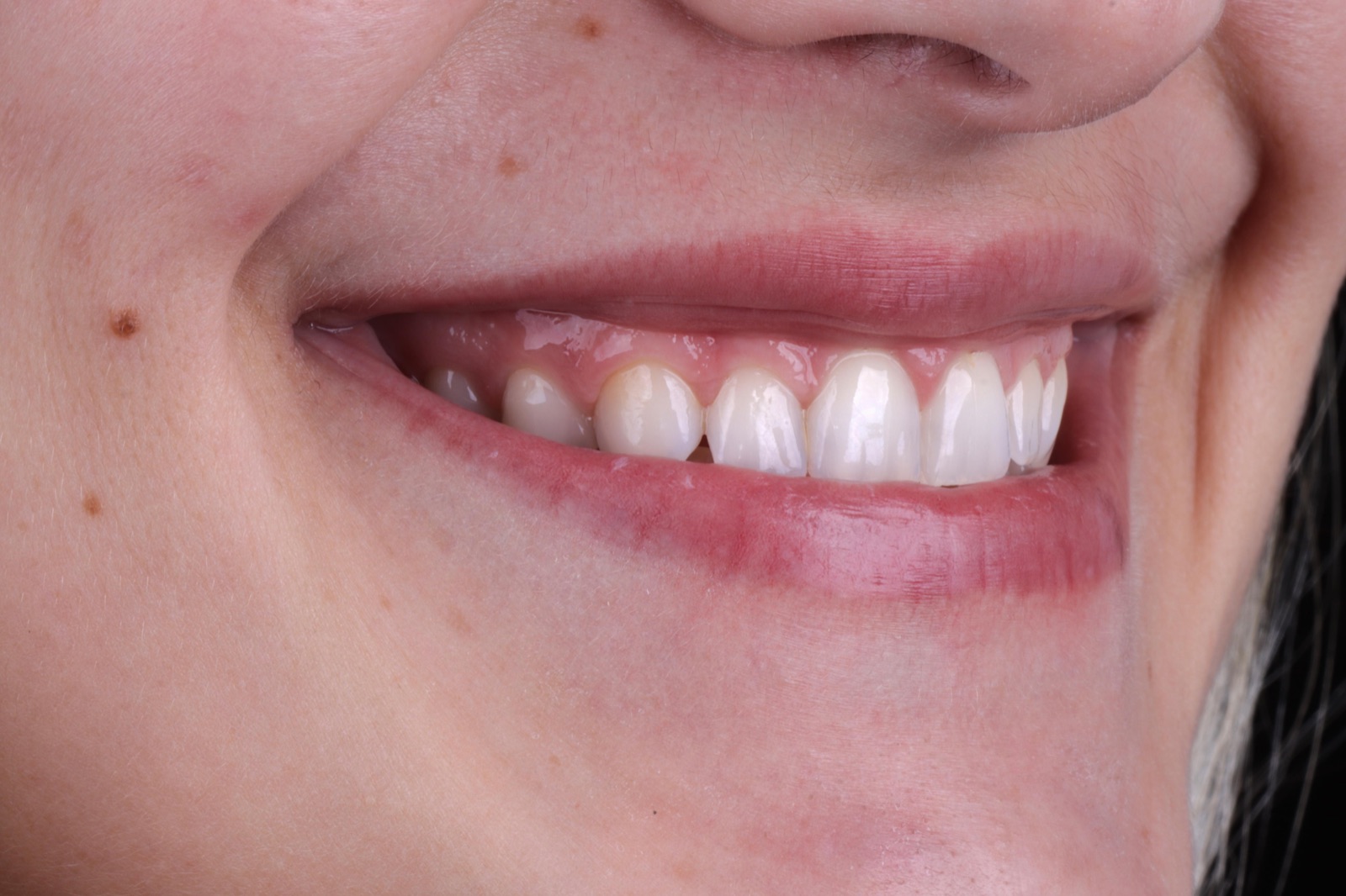 Sorriso reabilitado com implantes All-on-6